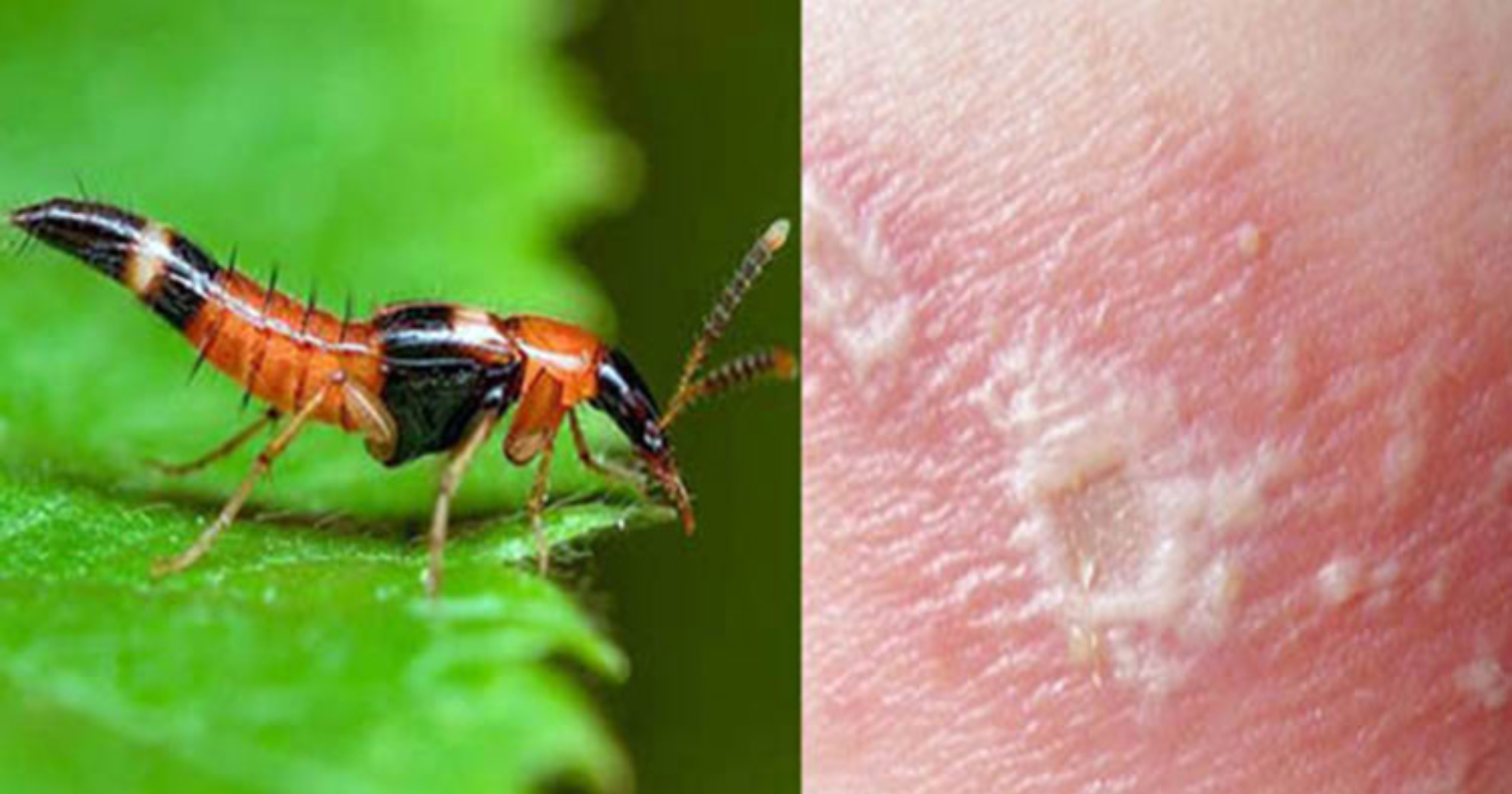 bị kiến ba khoang cắn